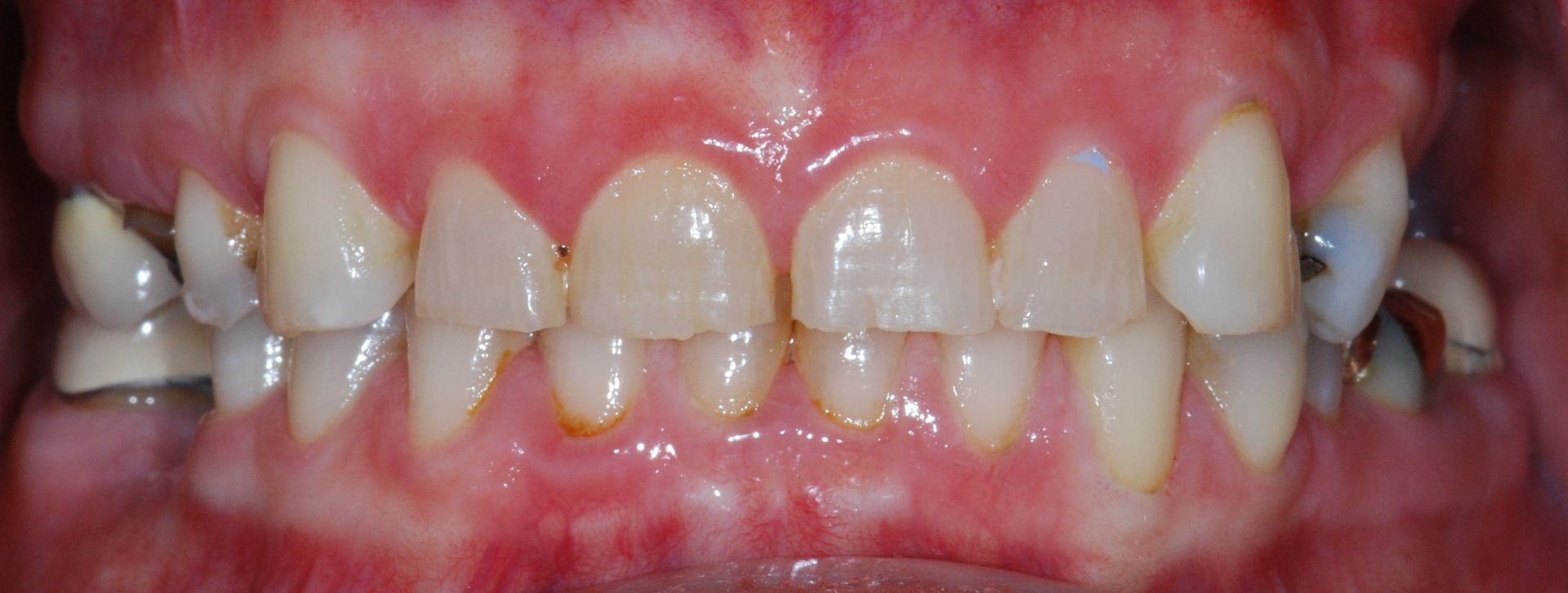 Close-up of a person's teeth. They are white, well-aligned, and surrounded by dark red gums.
