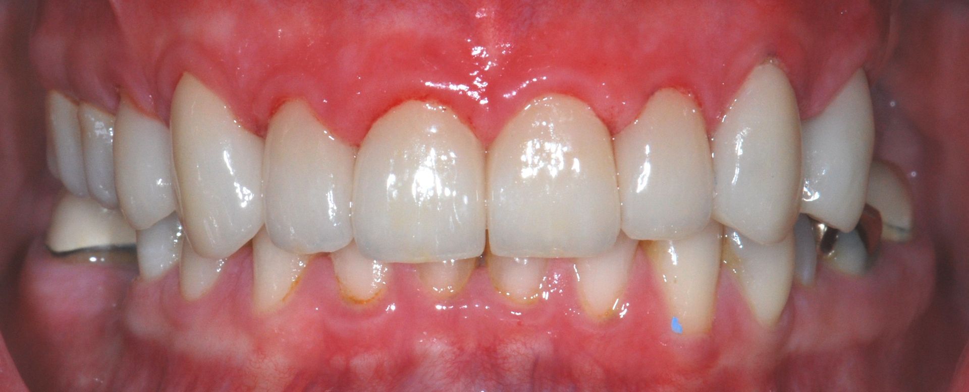 Close-up of human teeth showing healthy, white teeth and pink gums.