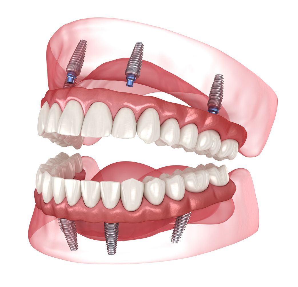 Model of a dental implant: a white crown is placed on a silver post that's screwed into the pink gum model.