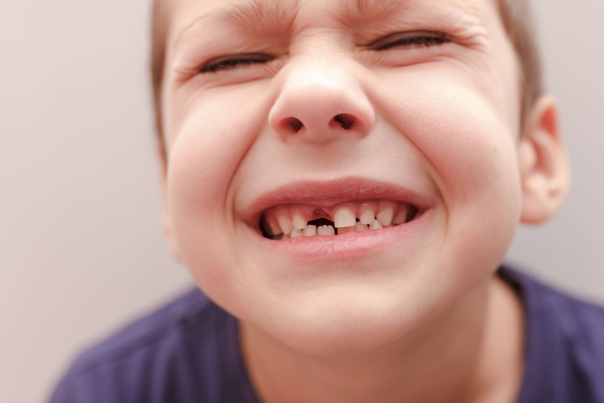 Close-up of a child with a missing front tooth smiling with eyes squinted, wearing a dark blue shirt.