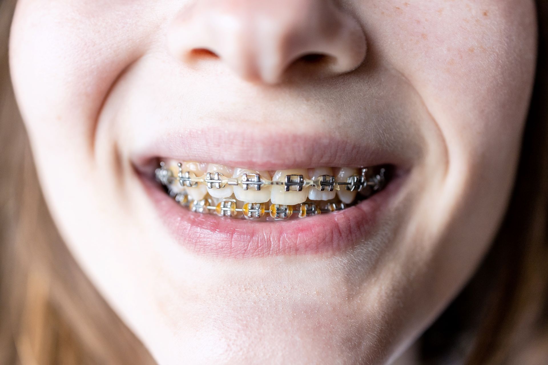 A close-up of a person smiling, showing their teeth with silver metal braces on both the upper and lower arches.