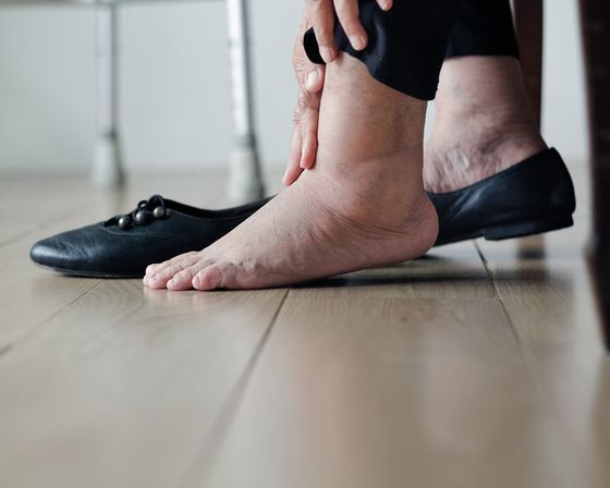 Diabetes Podiatrist – Elderly Woman Swollen Feet in West Chester, PA