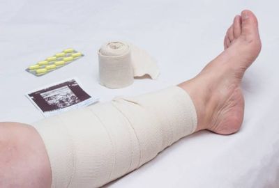 Varicose Veins Fayetteville Nc Fayetteville Vascular And Vein Center Pa