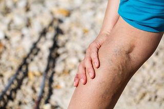 Painful Varicose Veins — Fayetteville, NC — Fayetteville Vascular and Vein Center, PA