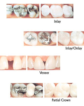 Inlay/Onlay, Venner & Partial Crown — Cosmetic dentistry in Katy, TX