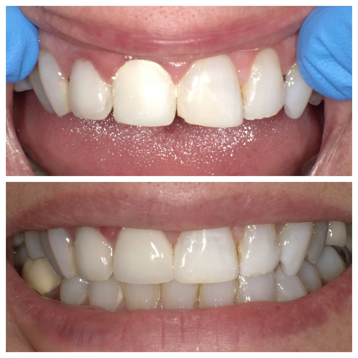 A before and after picture of a person 's teeth