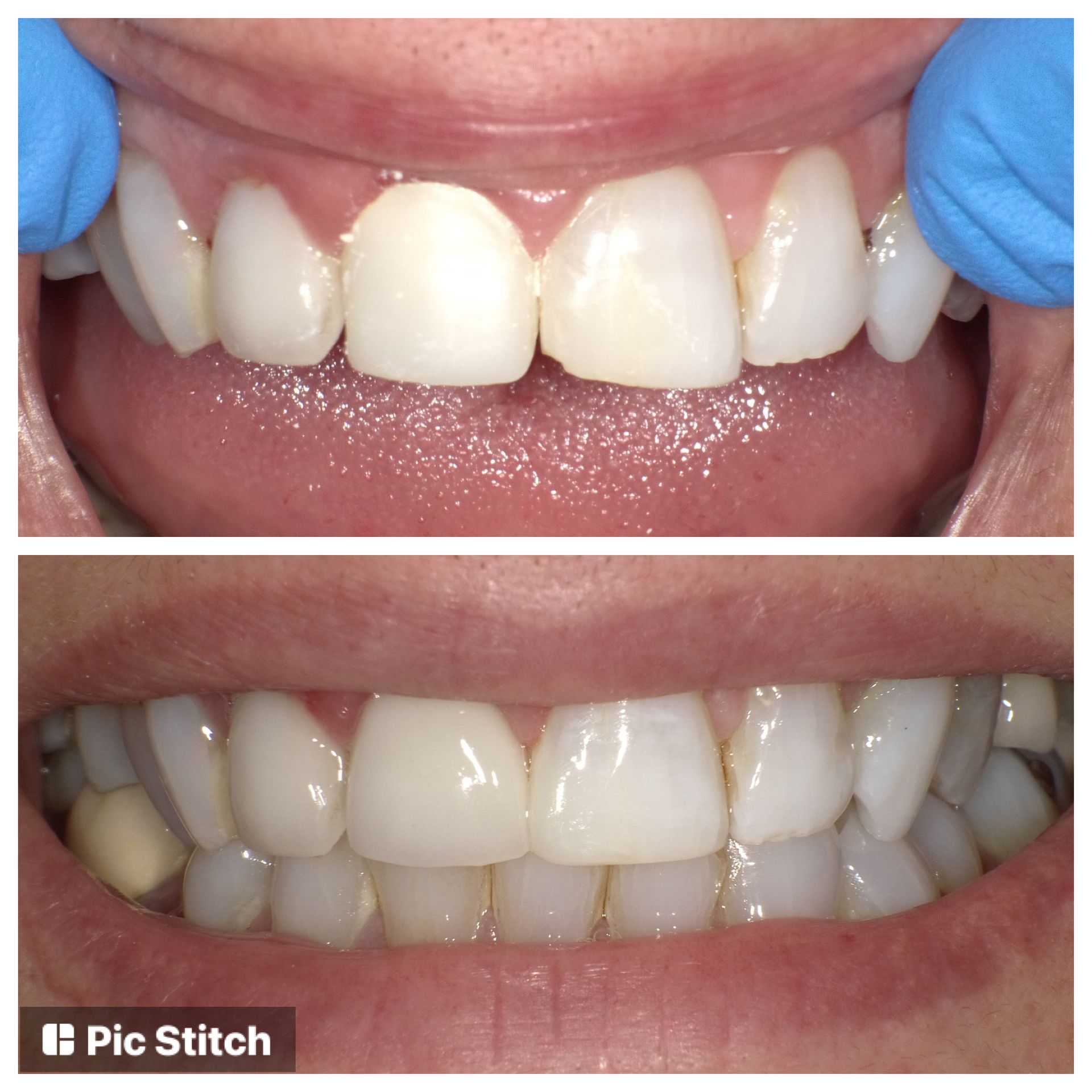 A before and after picture of a person 's teeth