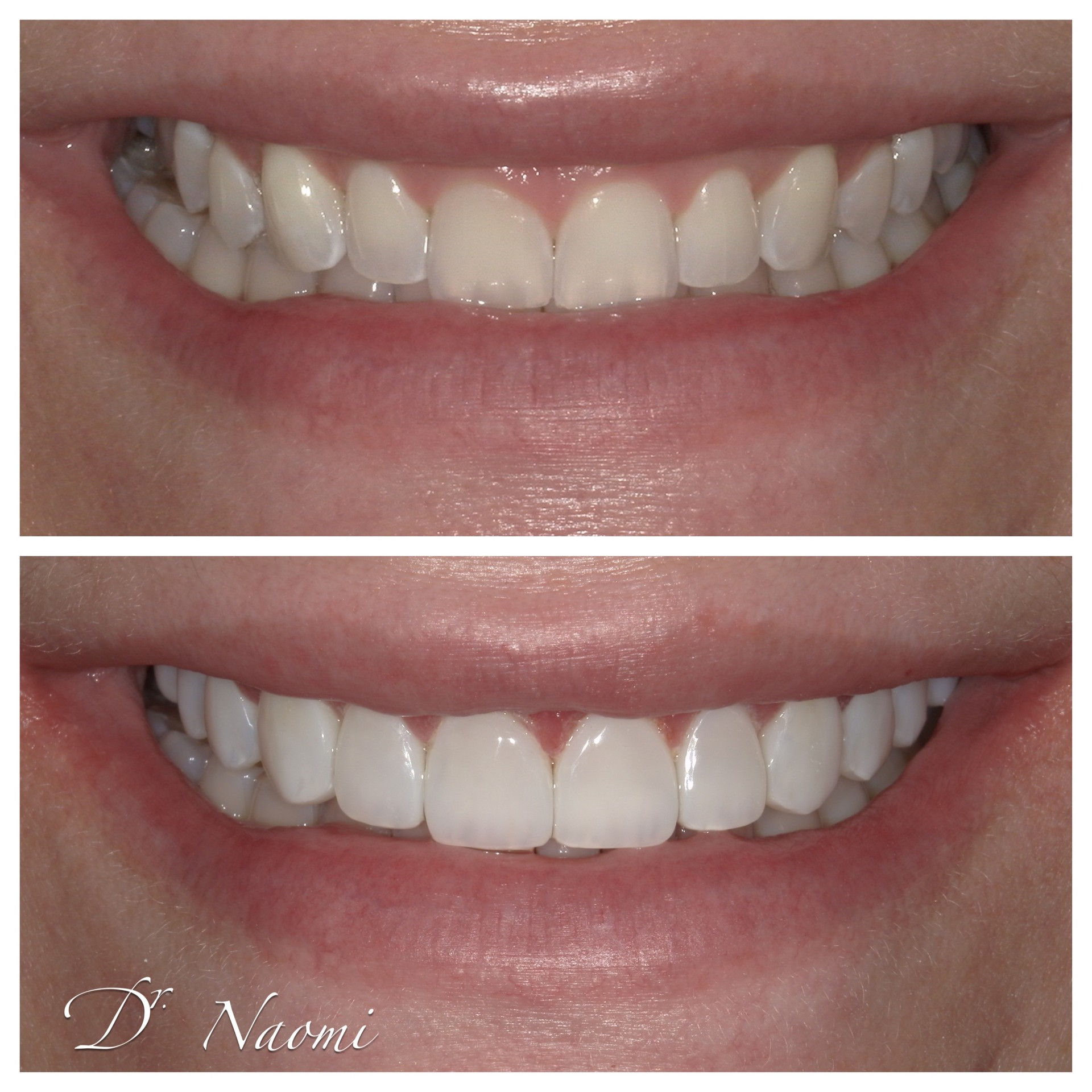 A before and after photo of a woman 's teeth by dr naomi