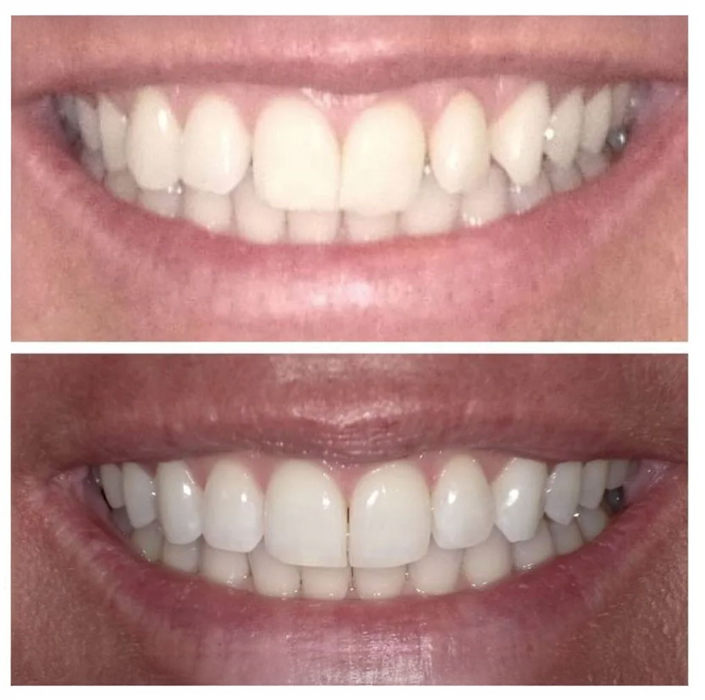 A before and after photo of a woman 's teeth.