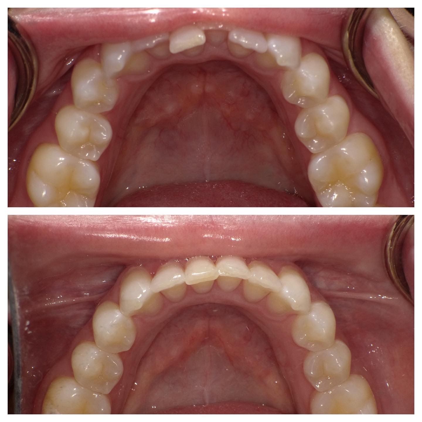 A before and after picture of a person 's teeth.