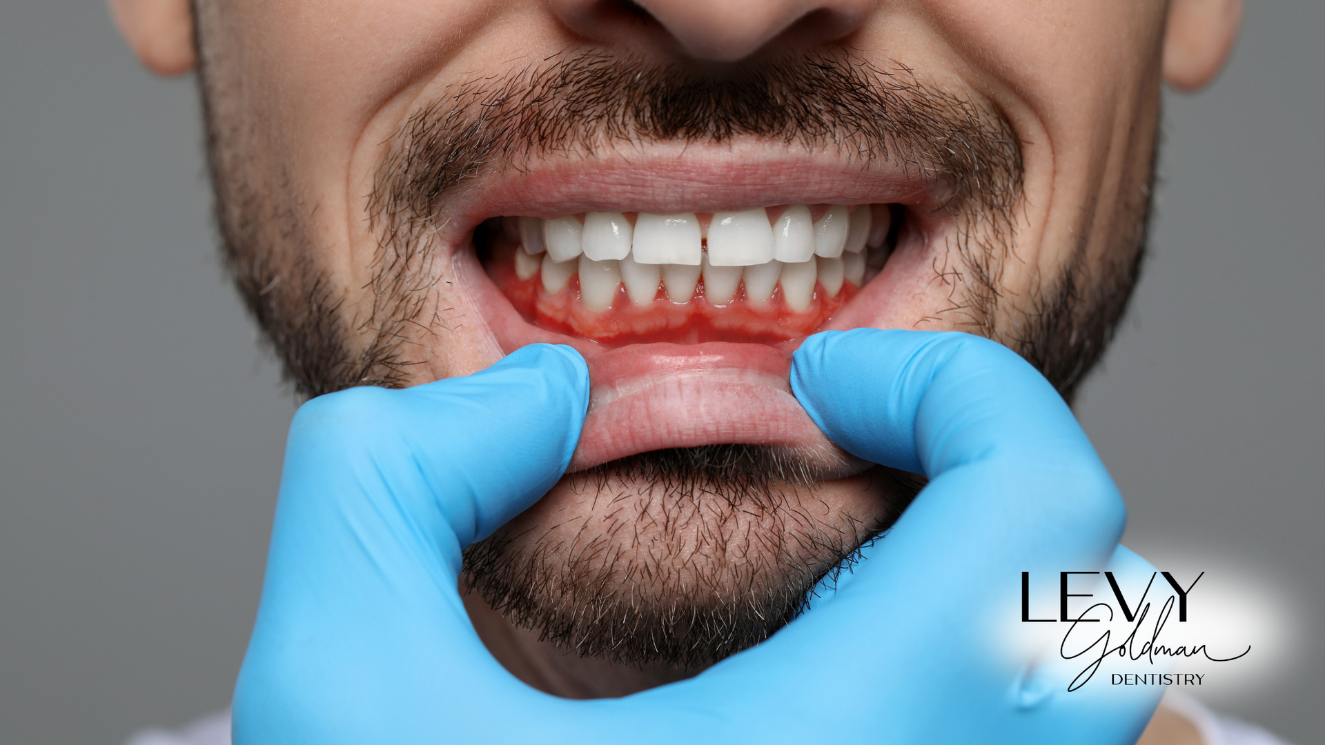 A man with a beard and blue gloves is being examined by a dentist.