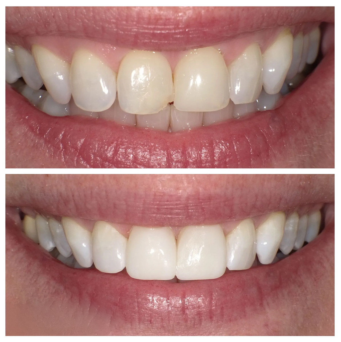 A picture of a woman 's teeth before and after whitening