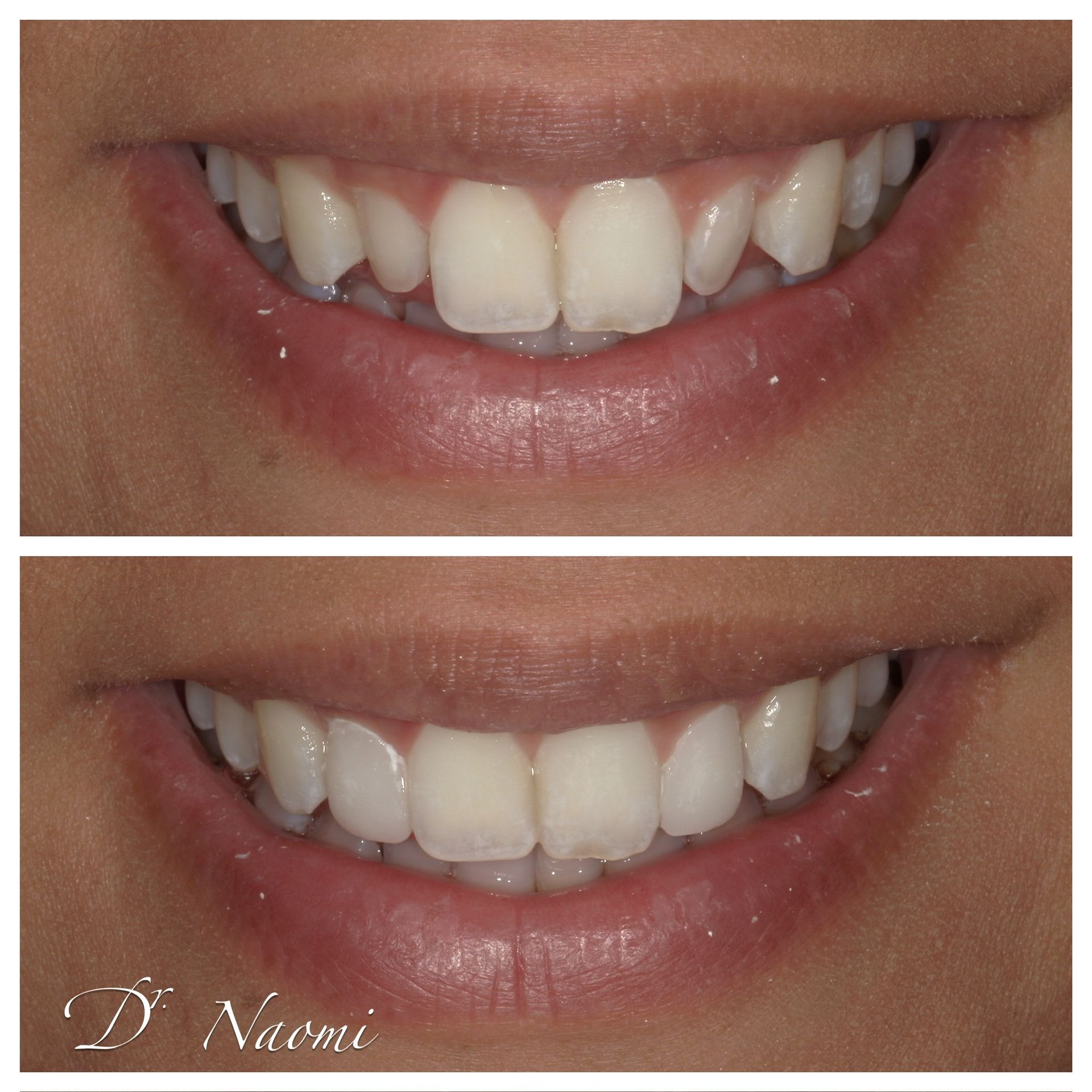 A before and after photo of a woman 's teeth.