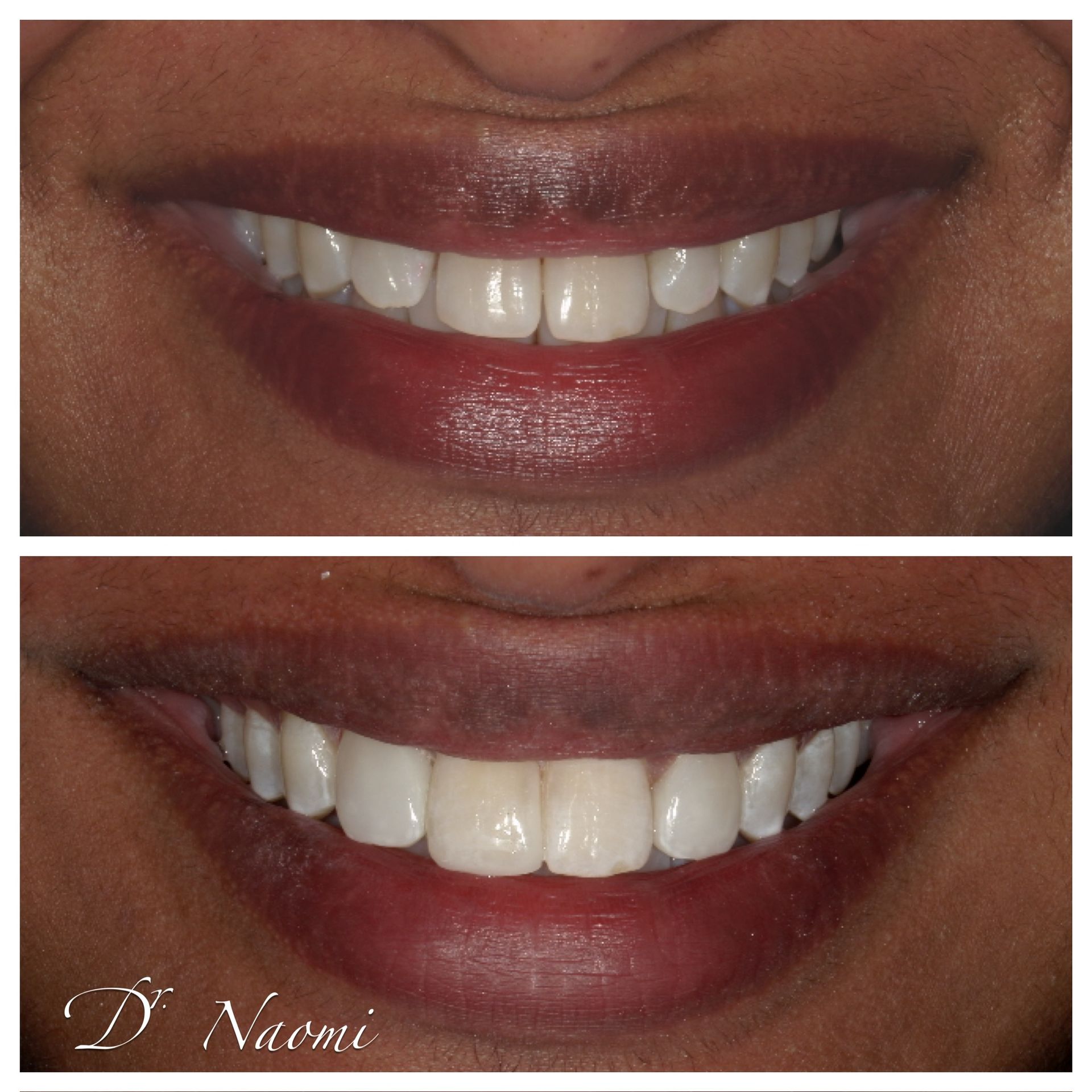 A before and after picture of a man 's teeth.