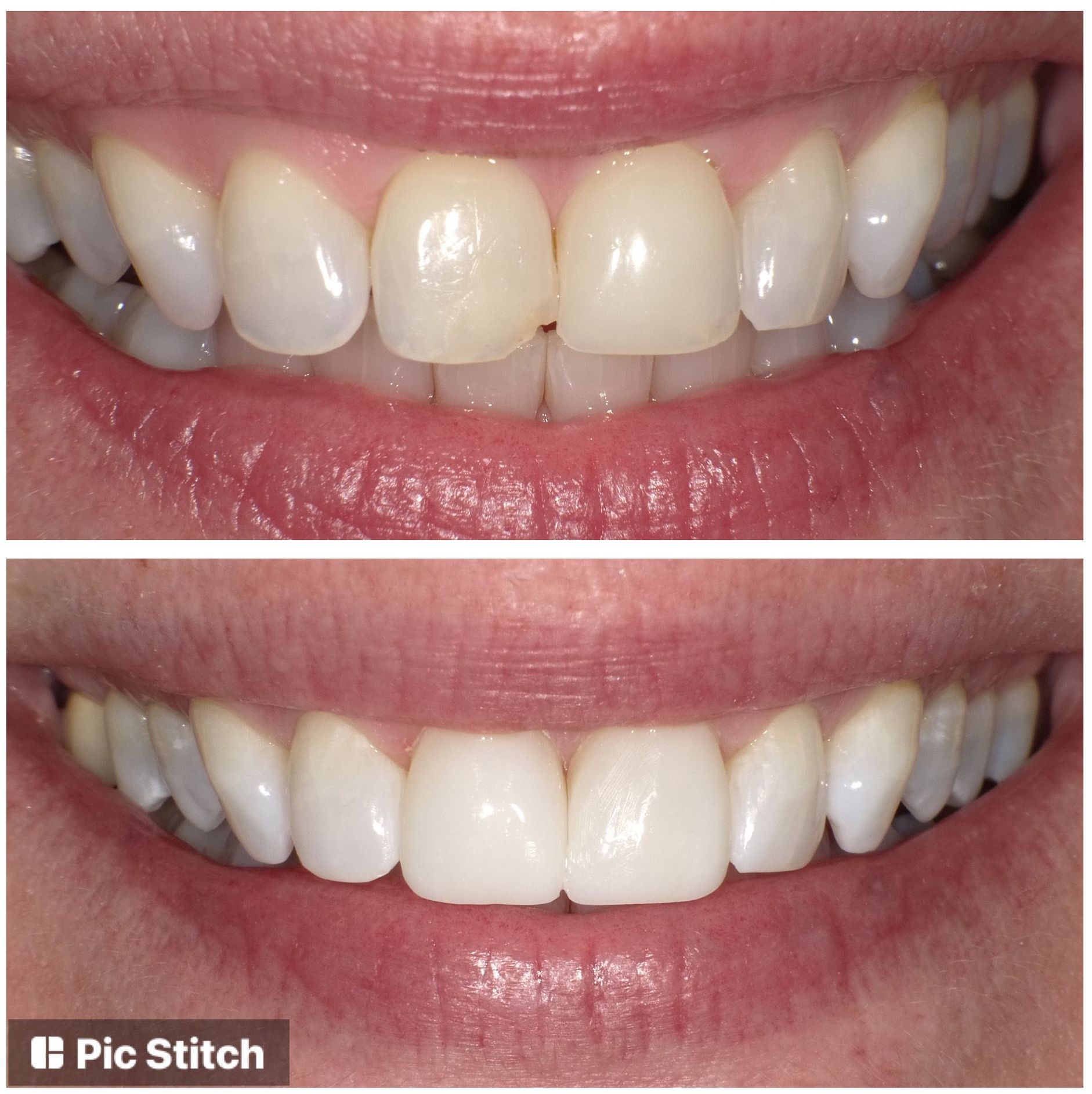 A picture of a woman 's teeth before and after whitening
