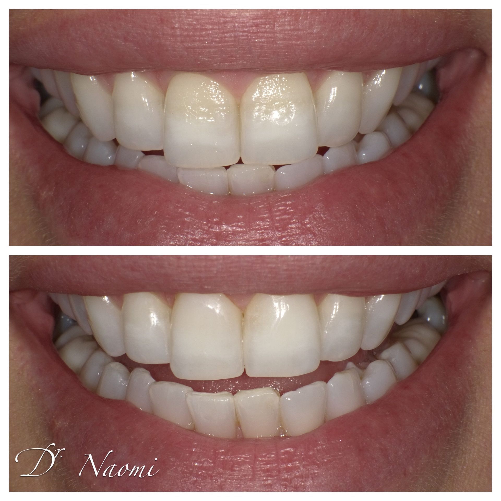 A before and after photo of a woman 's teeth by dr naomi