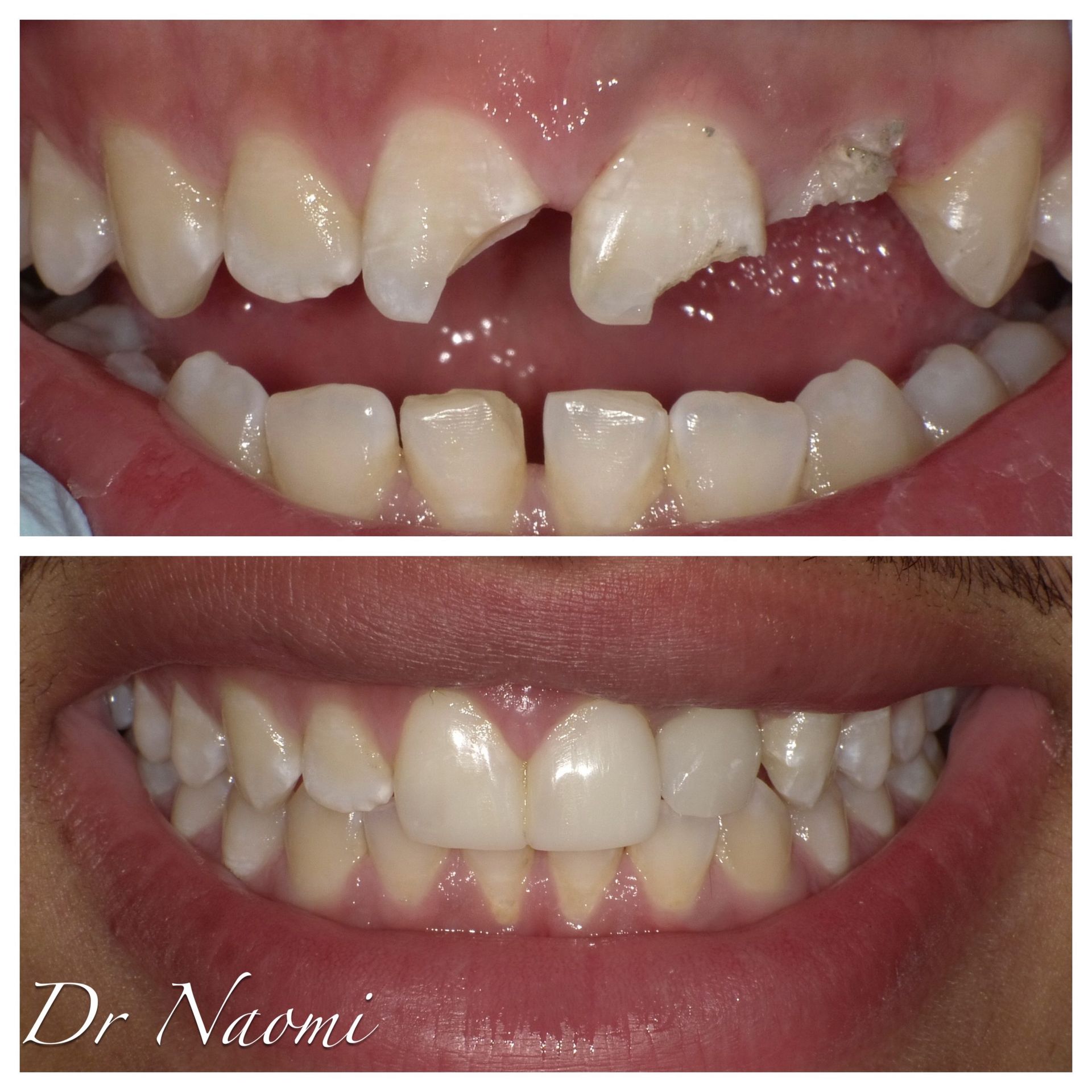 A before and after photo of a person 's teeth by dr. naomi