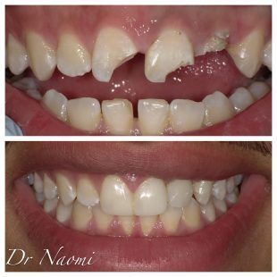 A before and after photo of a person 's teeth by dr naomi