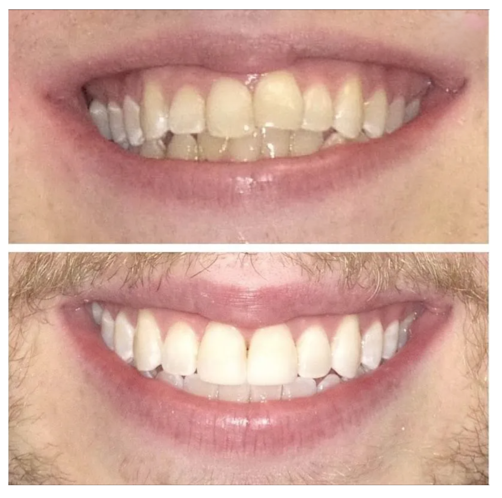 A before and after picture of a man 's teeth.