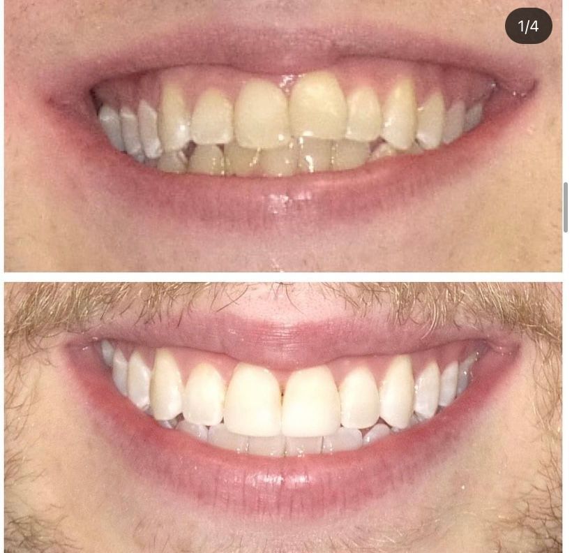 A before and after picture of a man 's teeth.
