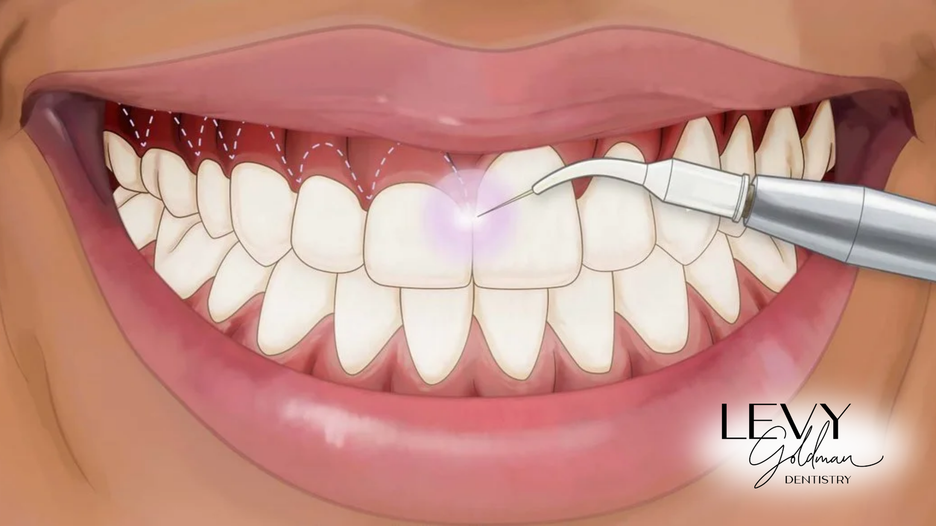 A close up of a person 's teeth being whitened with a laser.