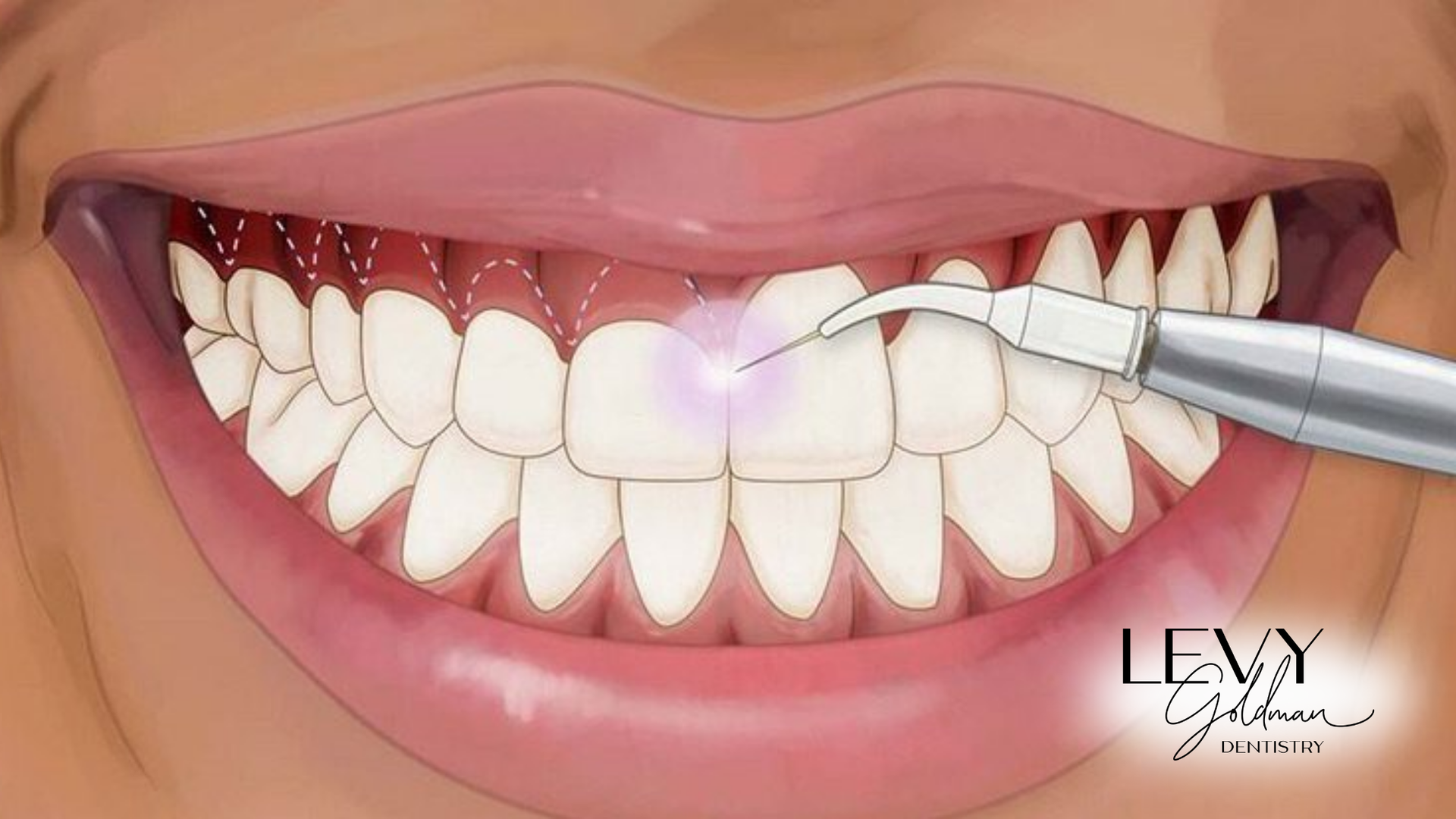 A close up of a person 's teeth being cleaned with a machine.