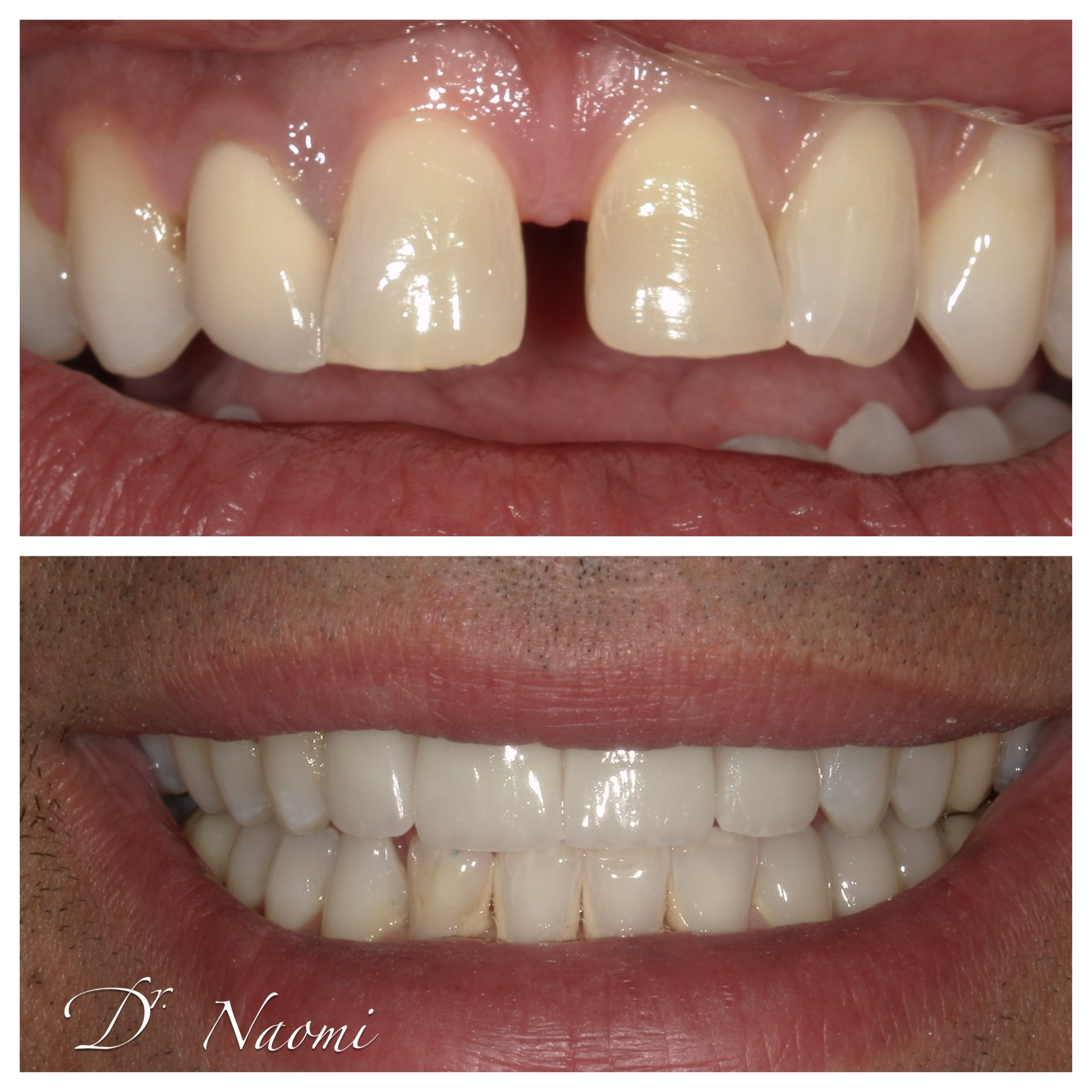 A before and after photo of a person 's teeth