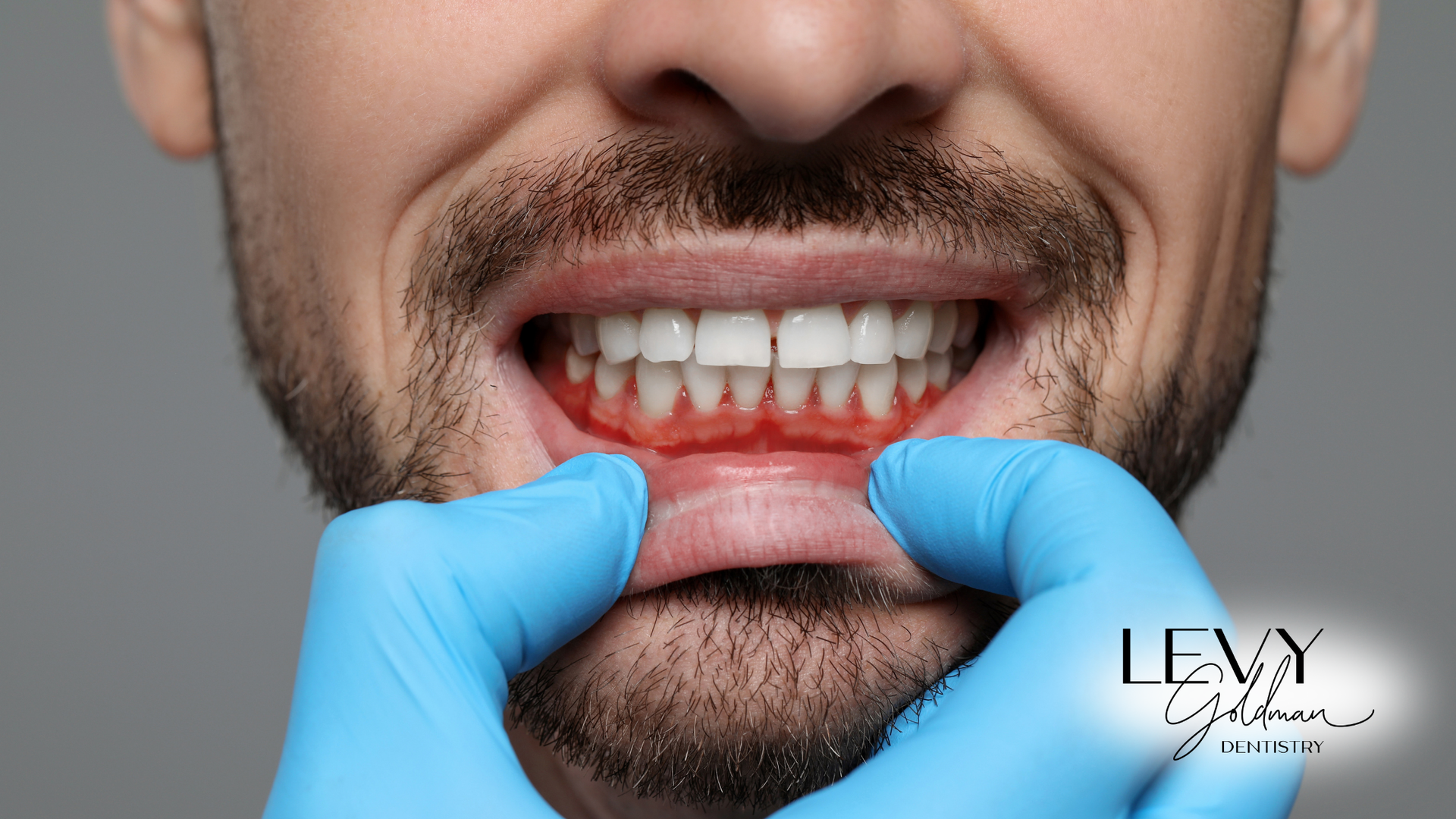 A man with a beard is being examined by a dentist.