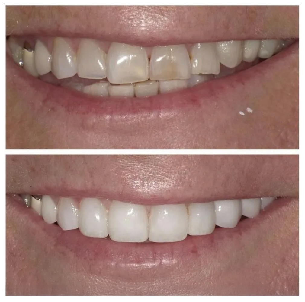 A before and after photo of a woman 's teeth