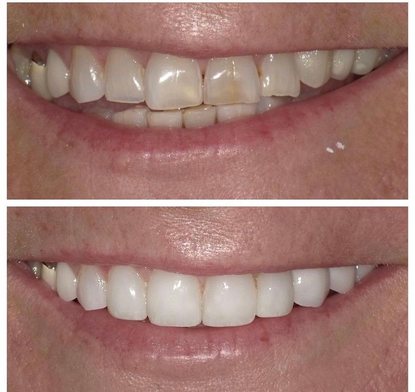 A before and after photo of a woman 's teeth