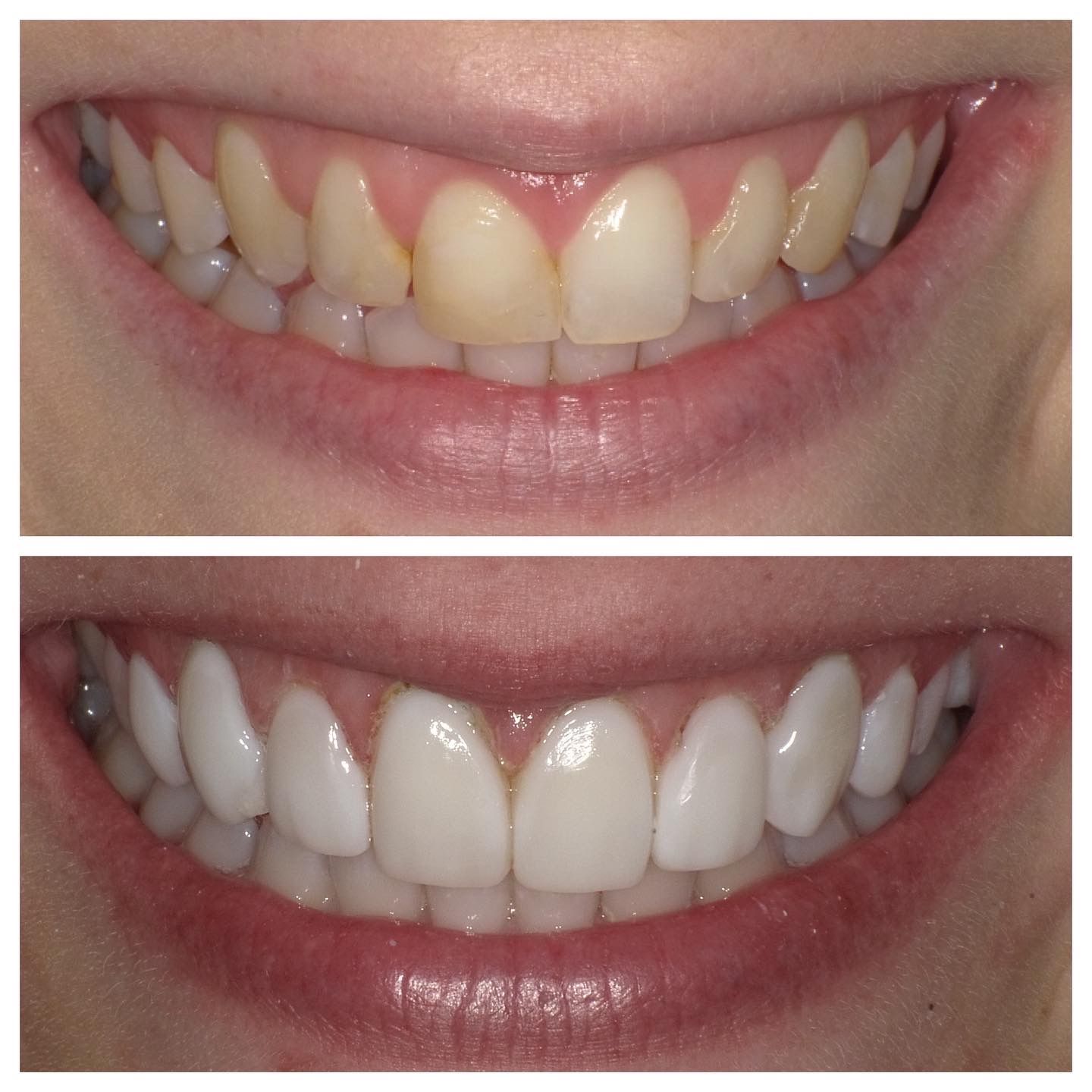 A before and after photo of a woman 's teeth.