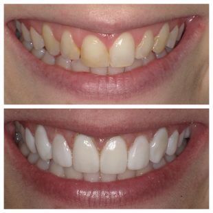 A before and after picture of a woman 's teeth
