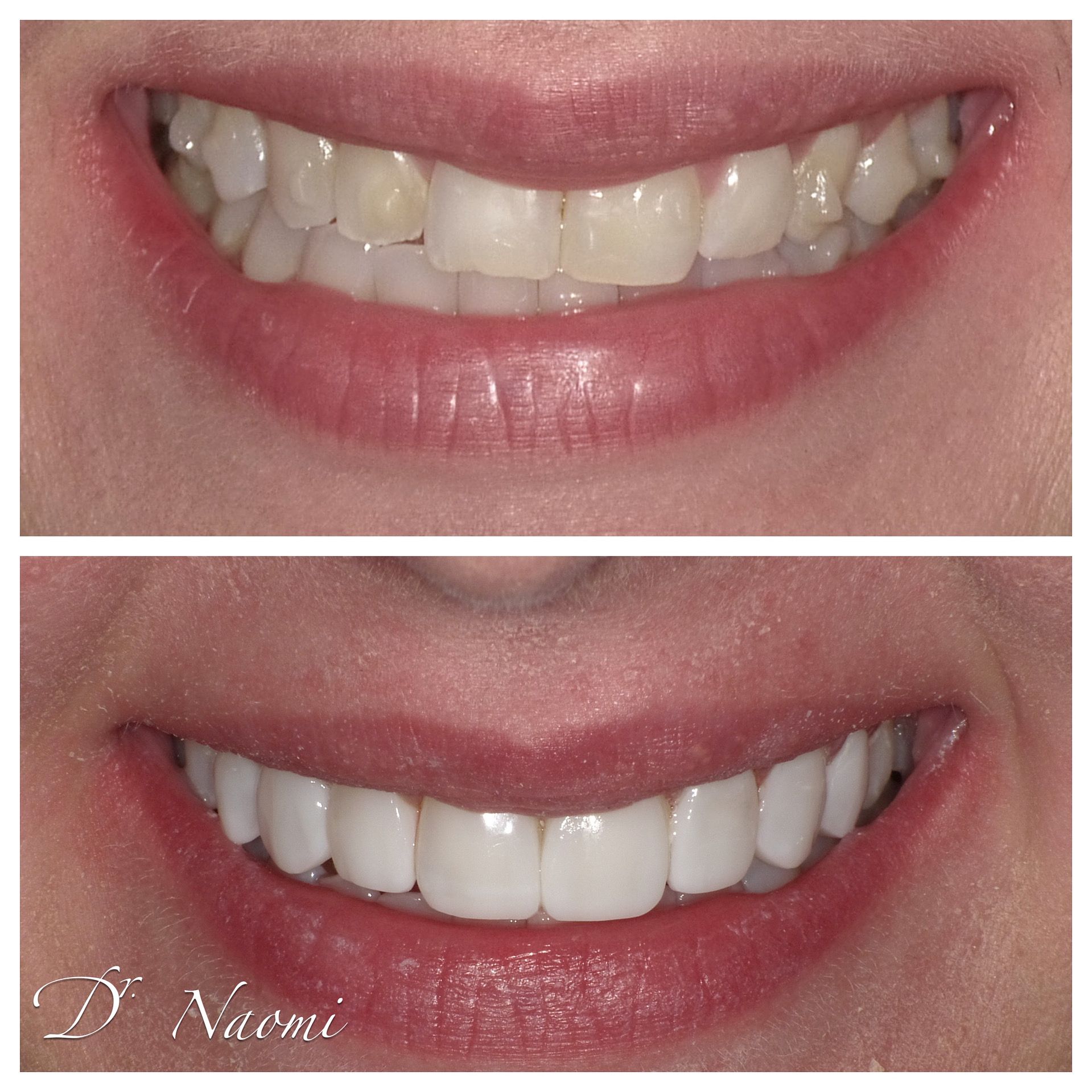 A before and after photo of a woman 's smile by dr naomi