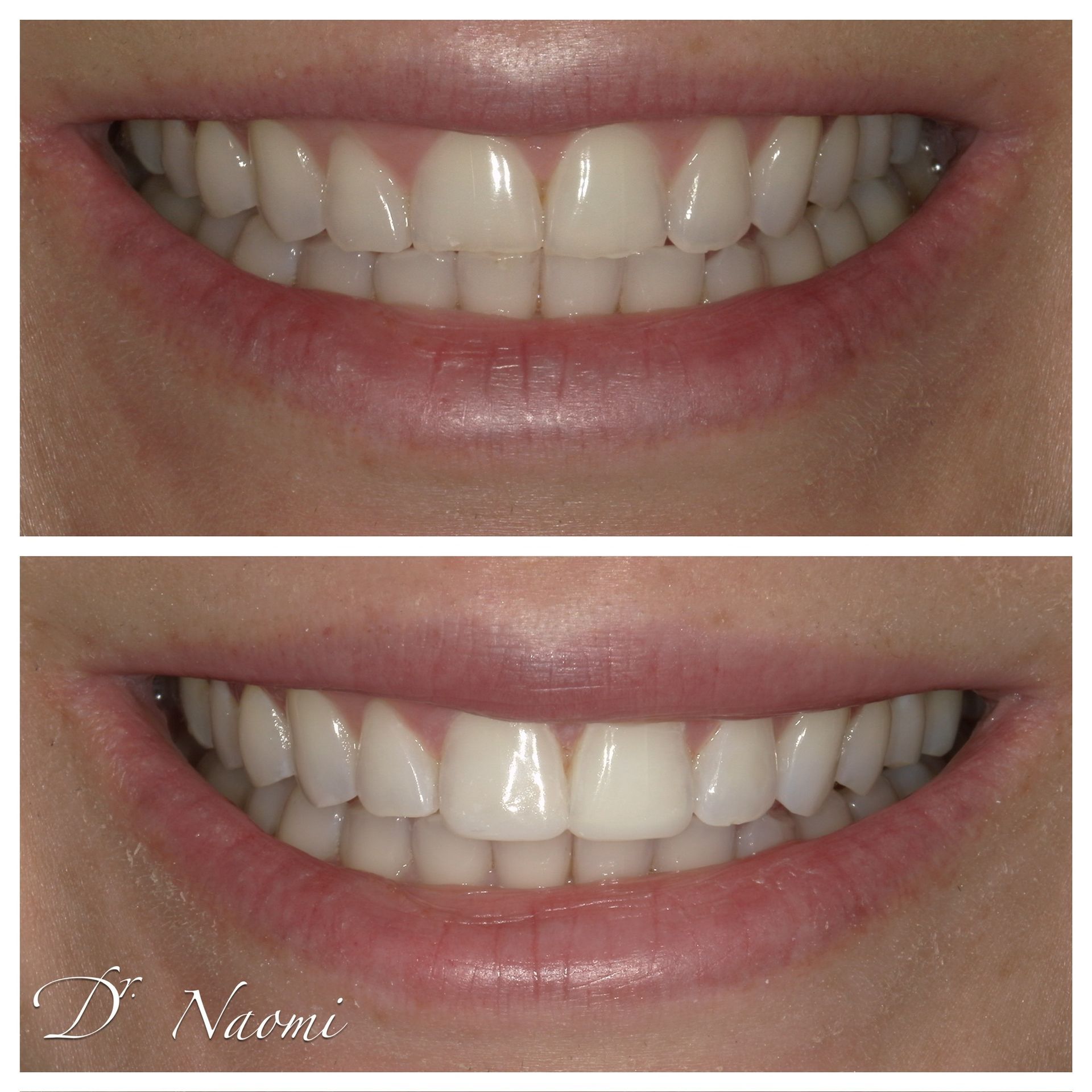 A before and after picture of a person 's teeth.
