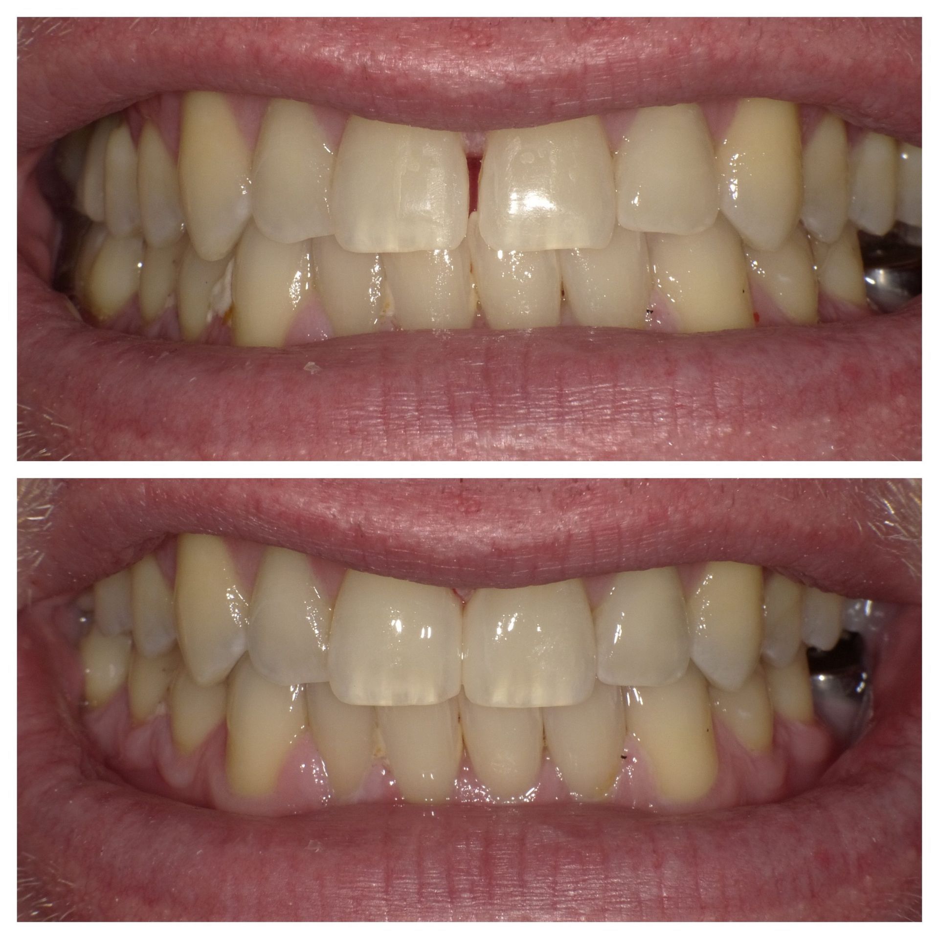 A before and after photo of a person 's teeth.