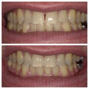 A before and after picture of a person 's teeth.