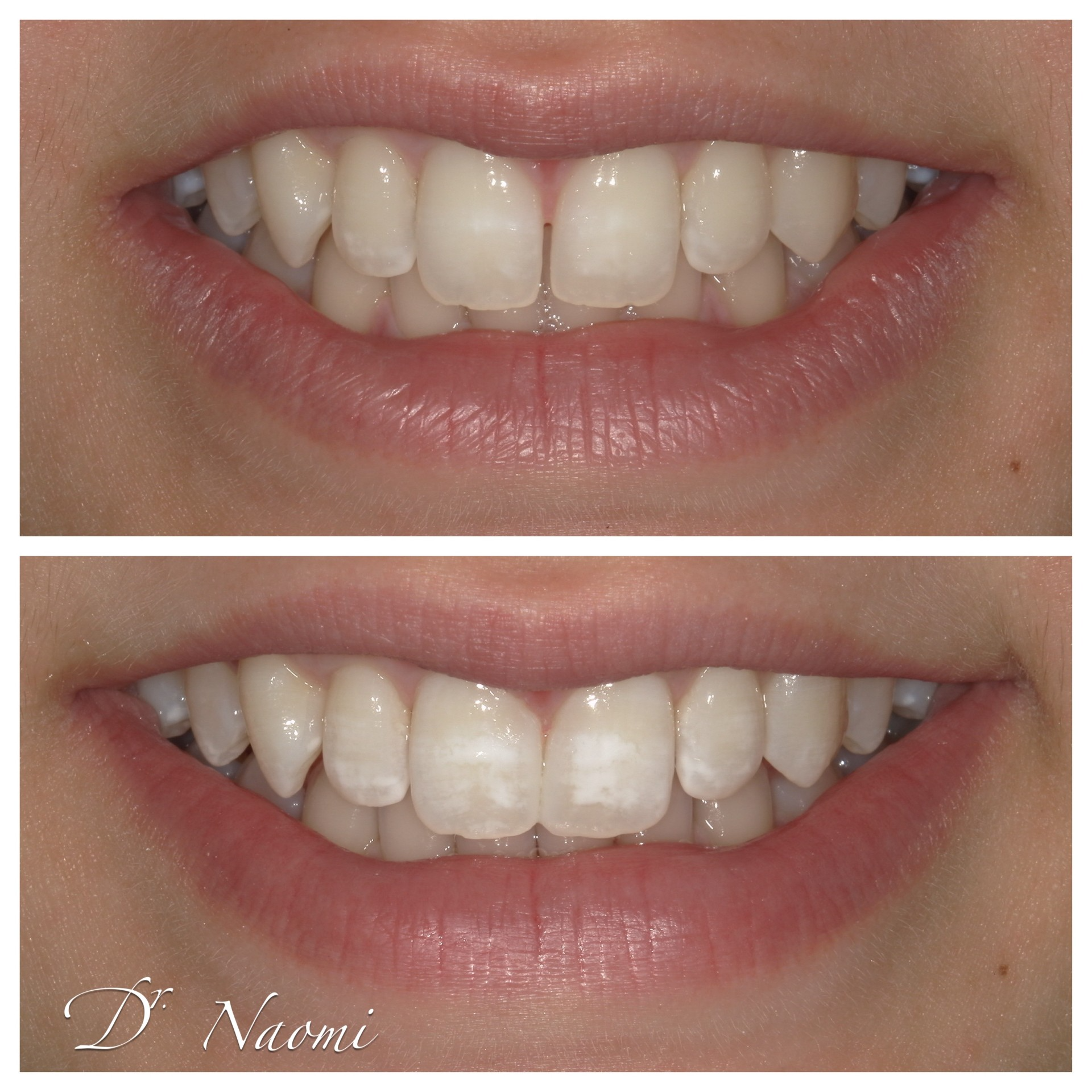 A before and after photo of a woman 's teeth by dr naomi
