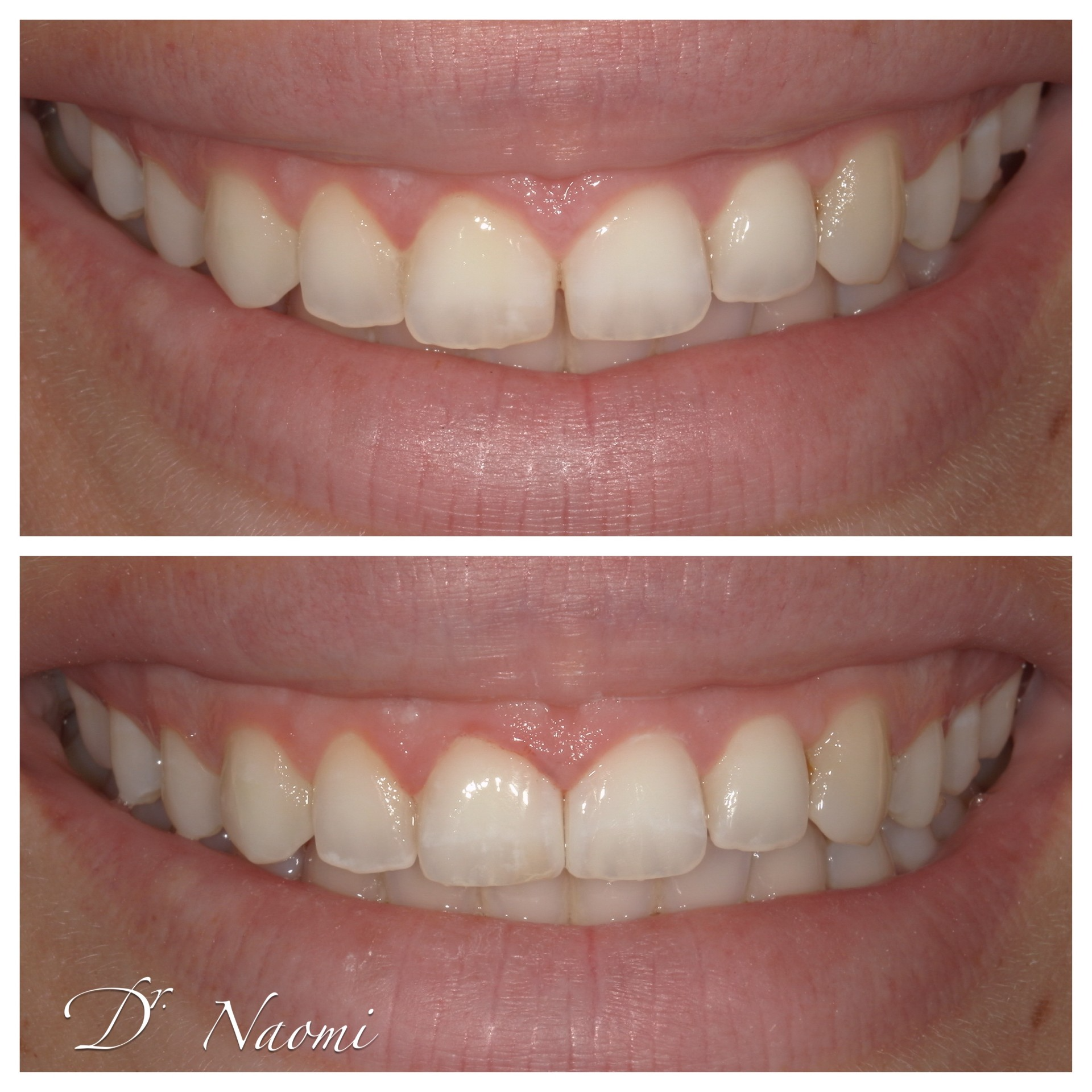 A before and after photo of a woman 's teeth by dr naomi