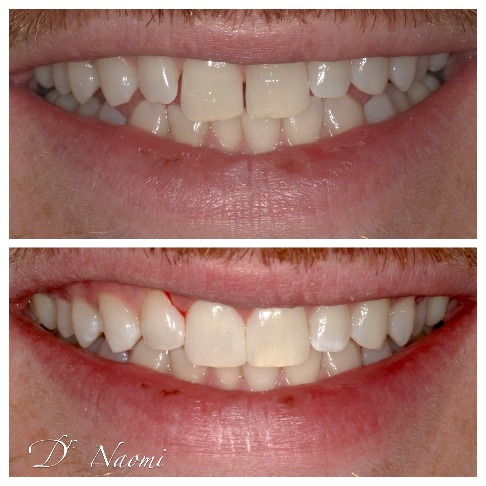A before and after photo of a person 's teeth by dr naomi