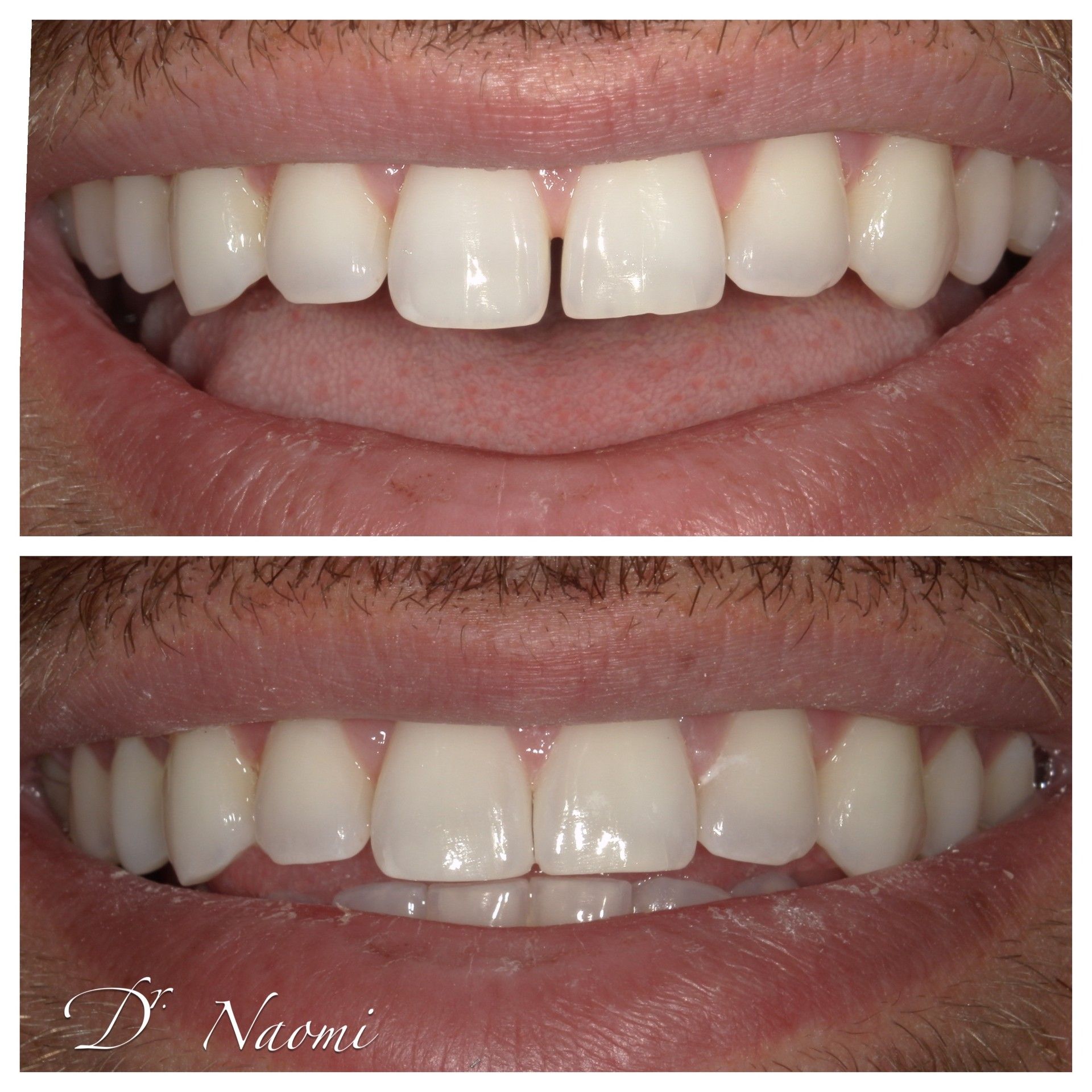 A before and after photo of a man 's teeth by dr naomi