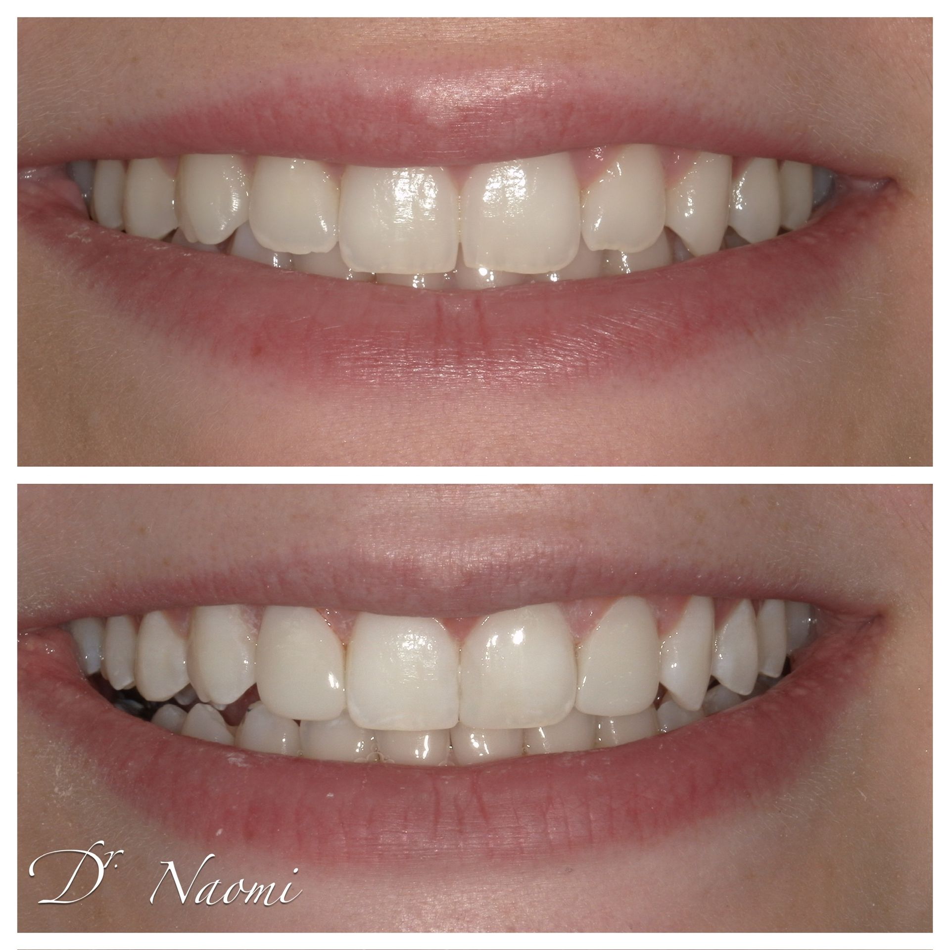 A before and after picture of a person 's teeth.