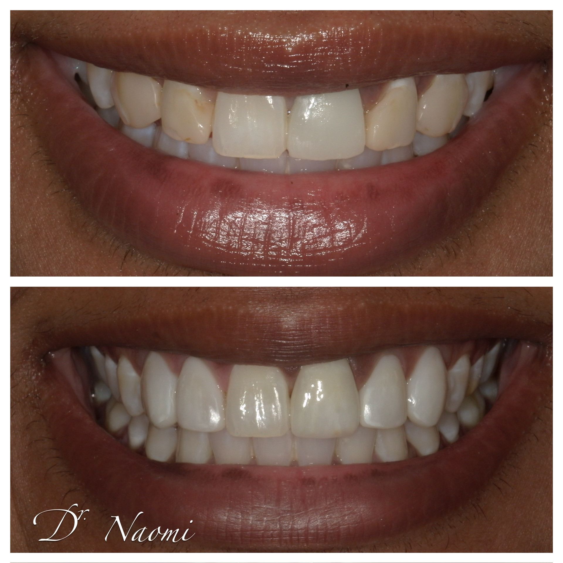 A before and after picture of a woman 's teeth