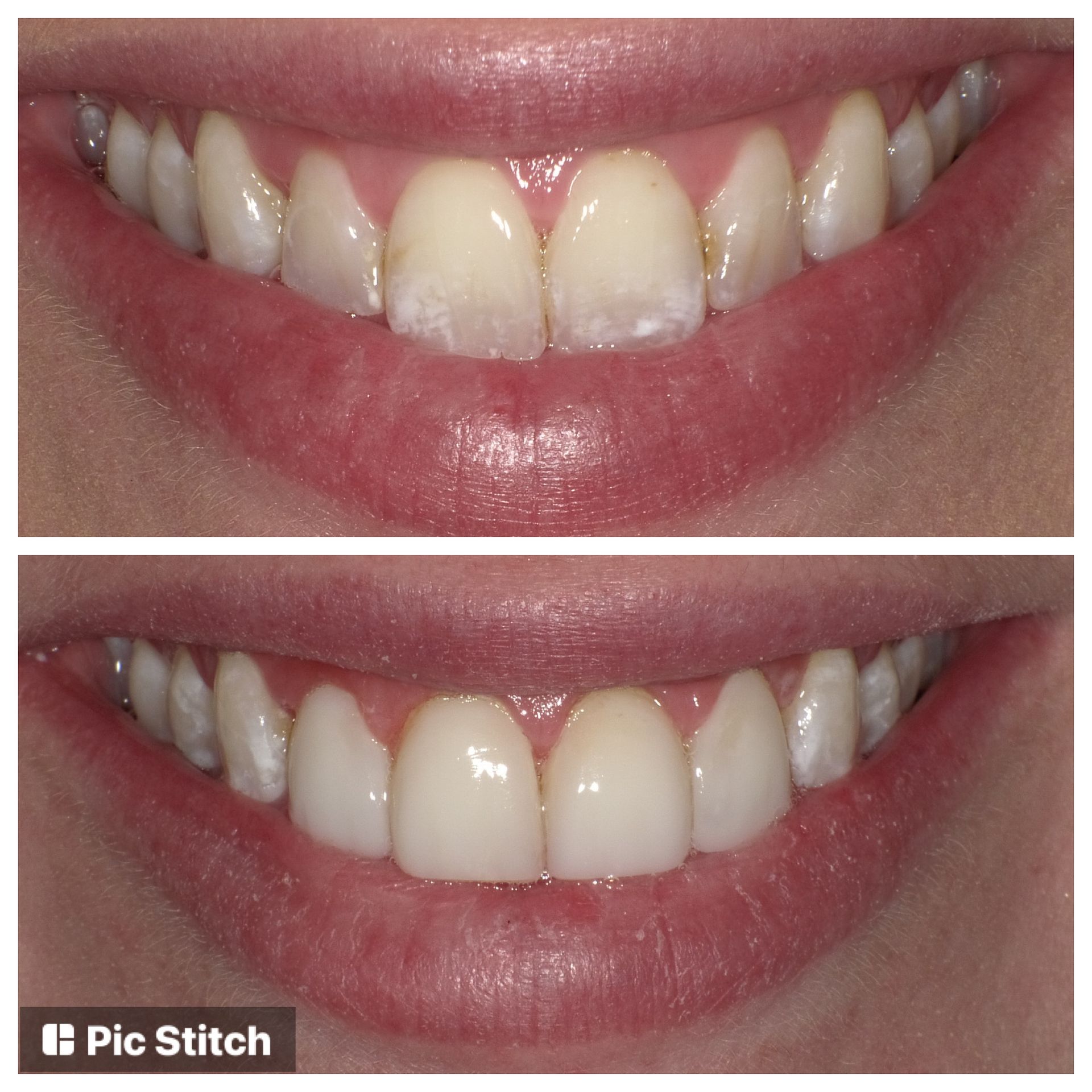 A before and after picture of a woman 's teeth.
