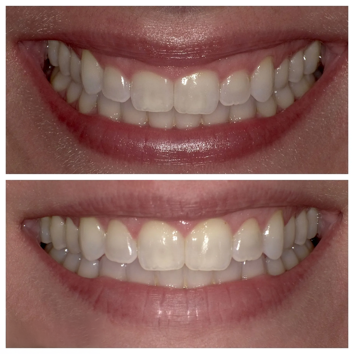 A before and after picture of a woman 's teeth.
