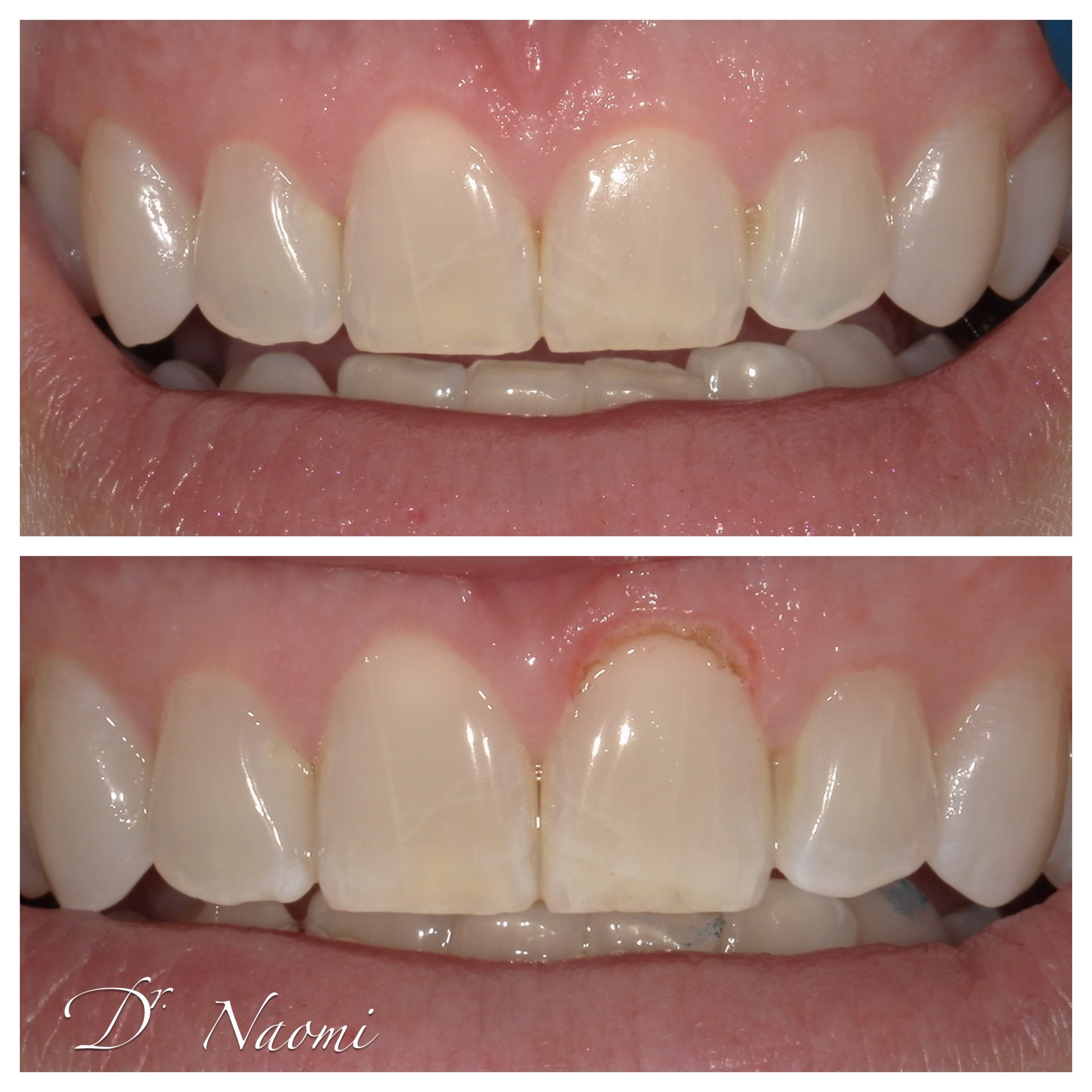 A before and after photo of a person 's teeth by dr naomi