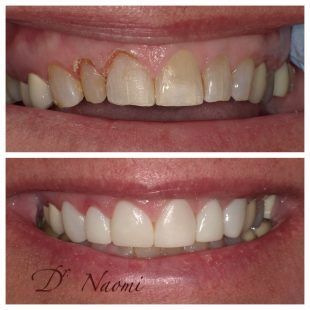 A before and after photo of a woman 's teeth.