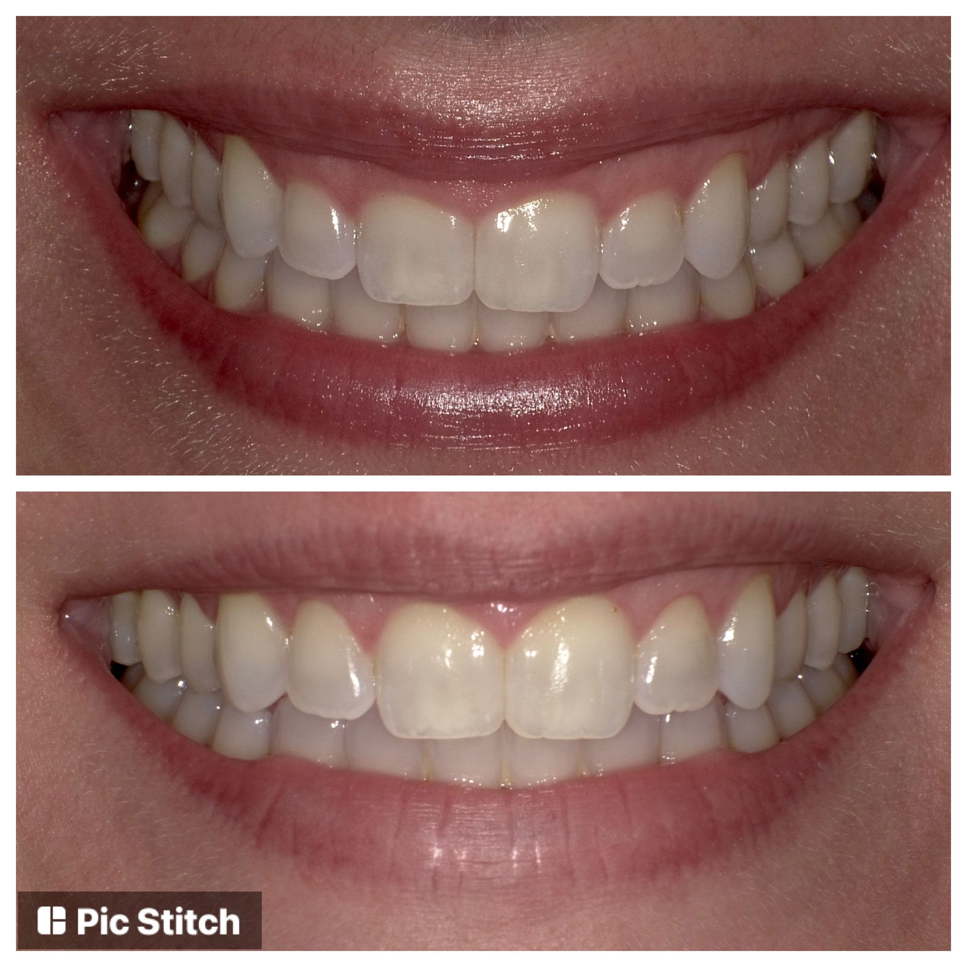 A before and after picture of a woman 's teeth.