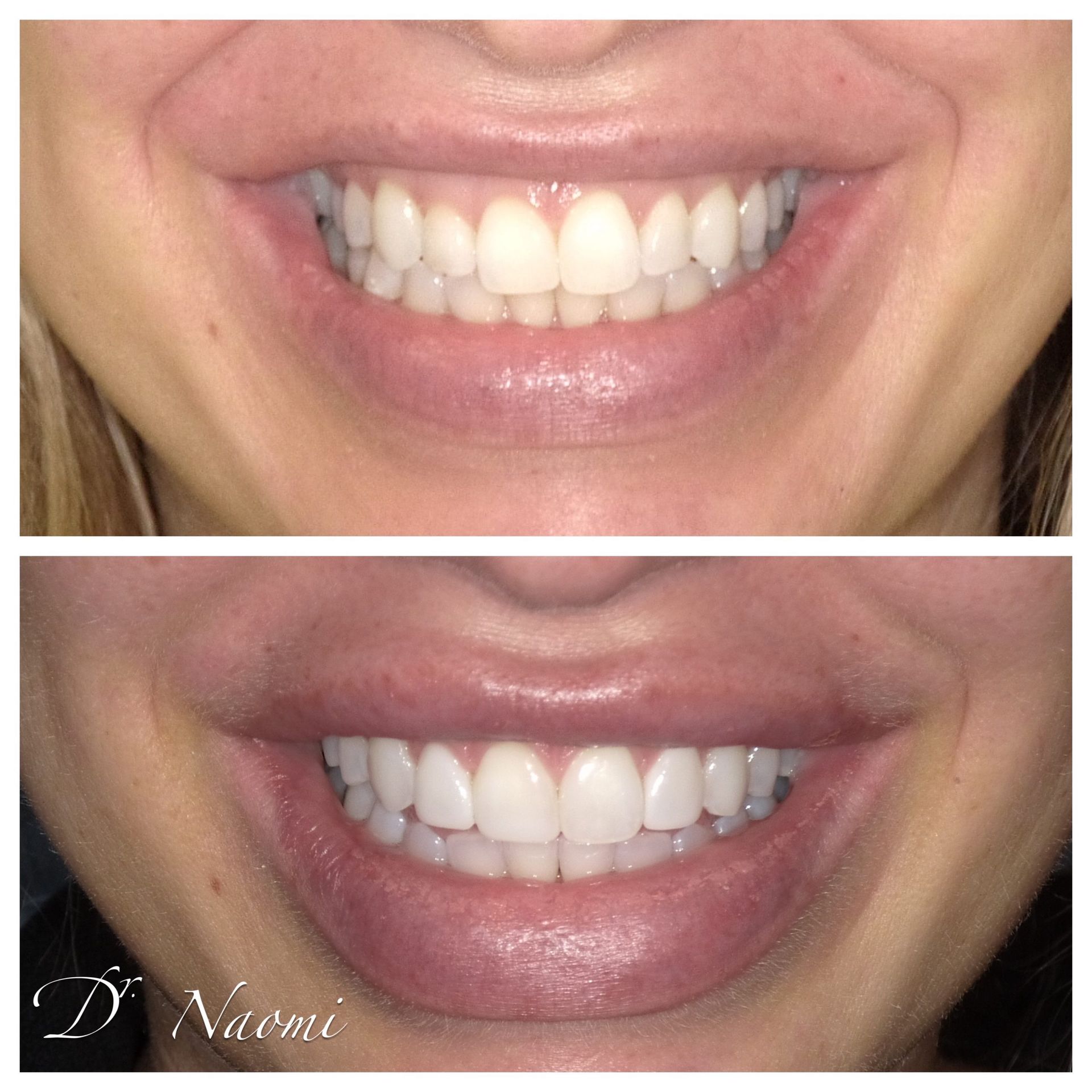 A before and after photo of a woman 's smile with white teeth.