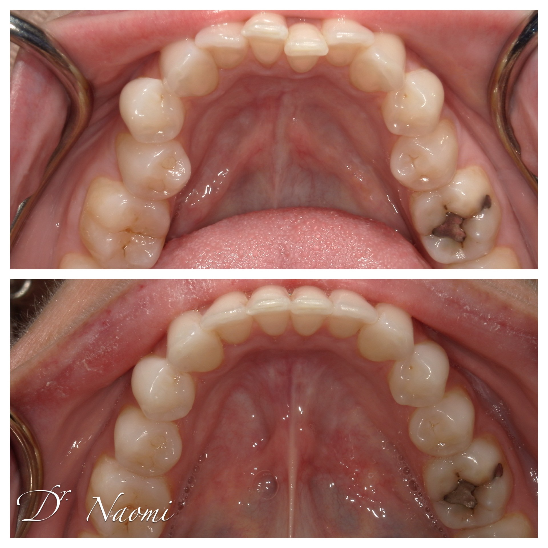 A before and after picture of a person 's teeth by dr naomi