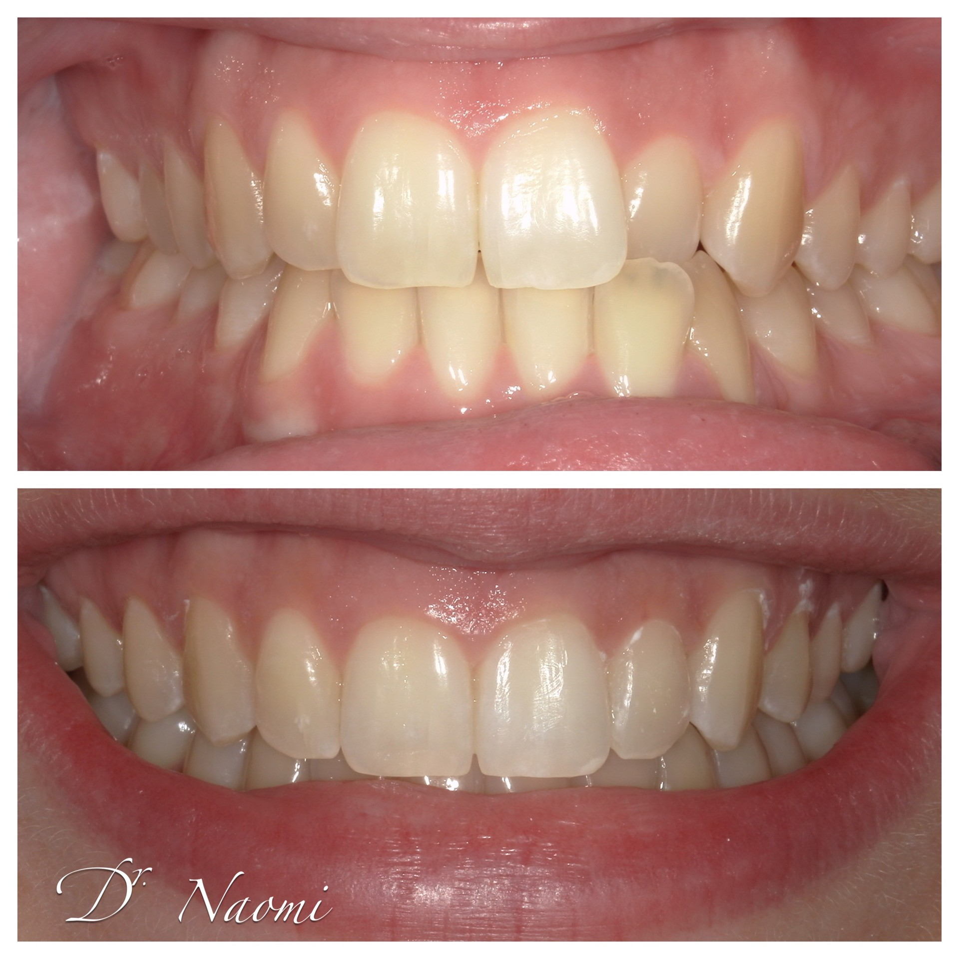 A before and after photo of a woman 's teeth by dr naomi
